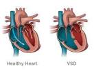 بیماری های قلبی مادرزادی VSD