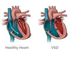 نقص دیواره بین بطنی (VSD)