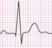 نوار قلب ECG EKG