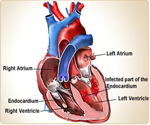 عفونت قلب و عروق قلب اندوکاردیت چیست و برای پیشگیری از عفونت قلب چه باید کرد؟