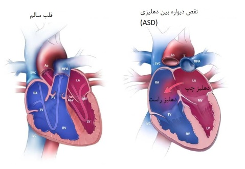 نقص دیواره بین دهلیزی فرق قلب سالم با سوراخ دیواره بین دهلیزی 