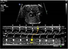 نامنظمی قلب جنین fetal arrhythmia